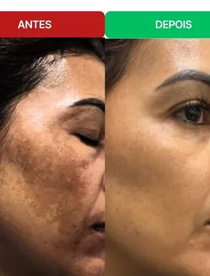Antes e depois de uma aluna: manchas na testa e na bochecha bem mais claras