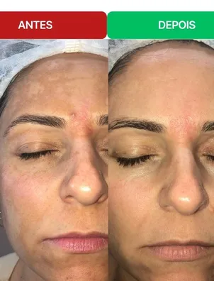 Antes e depois de uma aluna: manchas ao redor dos olhos bem mais claras