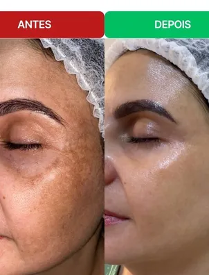 Antes e depois de uma aluna: manchas na testa e nas maçãs do rosto bem mais claras